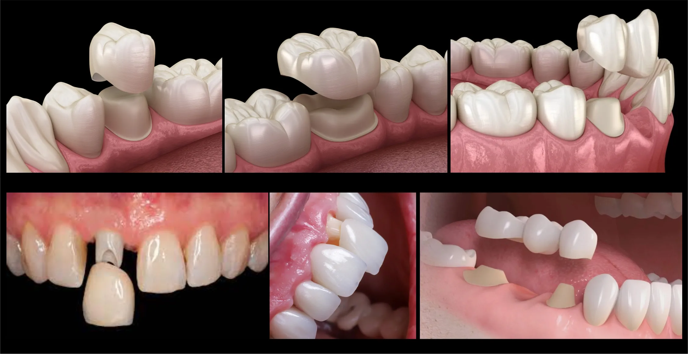 coronas dentales en porcelana como cambia una sonrisa